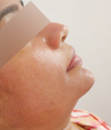 After Chin Filler