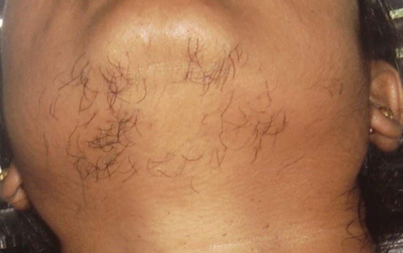 Before Chin and Front Neck Hair Removal