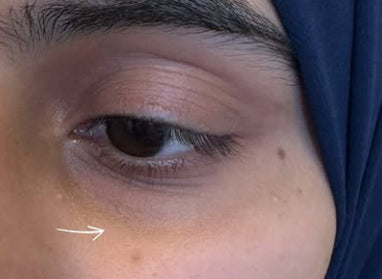 Before Under Eye Filler