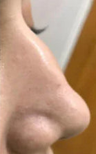 Before: Nose Shape Concerns