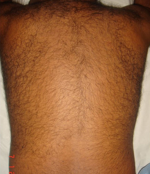 Before: Abdominal & Back Hair