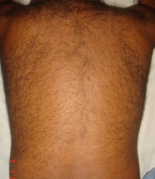 Before Abdominal and Back Hair Removal