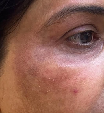 Before: Skin Texture & Tone