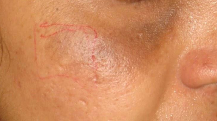 Before Pigmentation on Cheeks Treatment