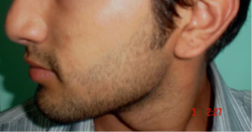 After Beard Line Hair Removal