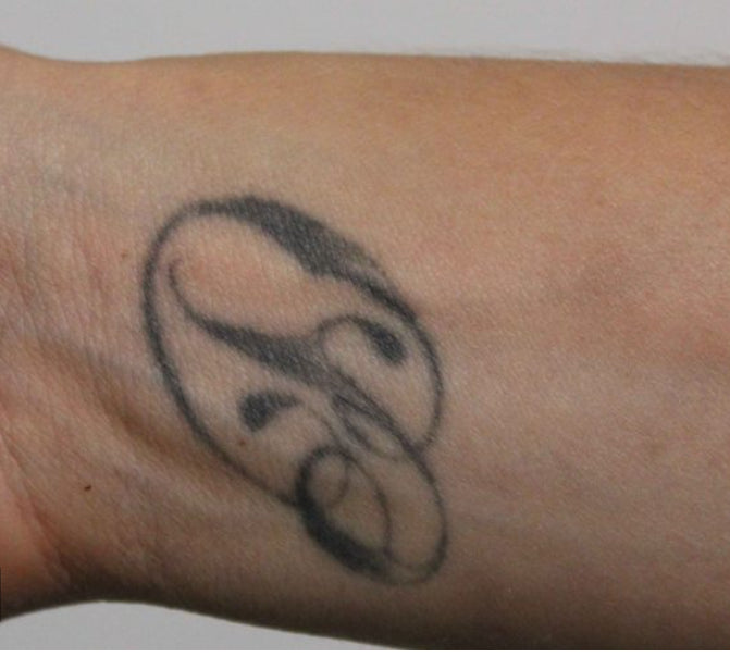 Before Laser Tattoo Removal