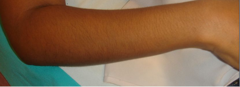 Before Hand Hair Removal