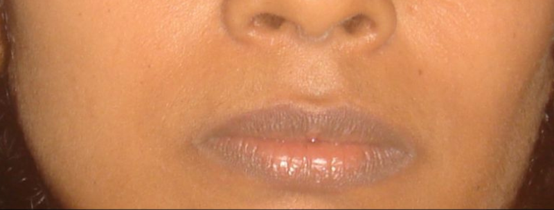 After Upper Lip Hair Removal