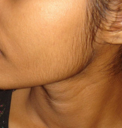 Before Cheeks Hair Removal