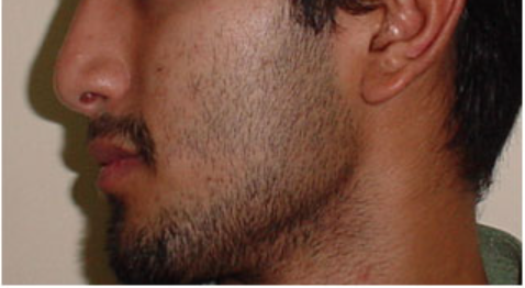Before Beard Line Hair Removal