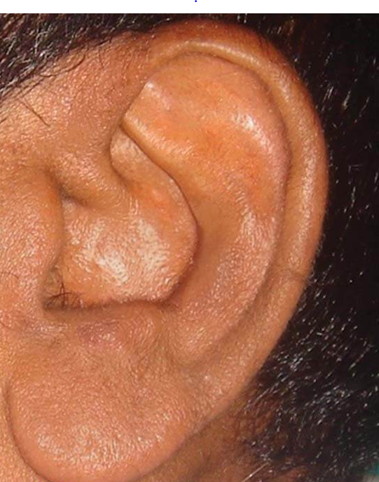 After Ear Hair Removal