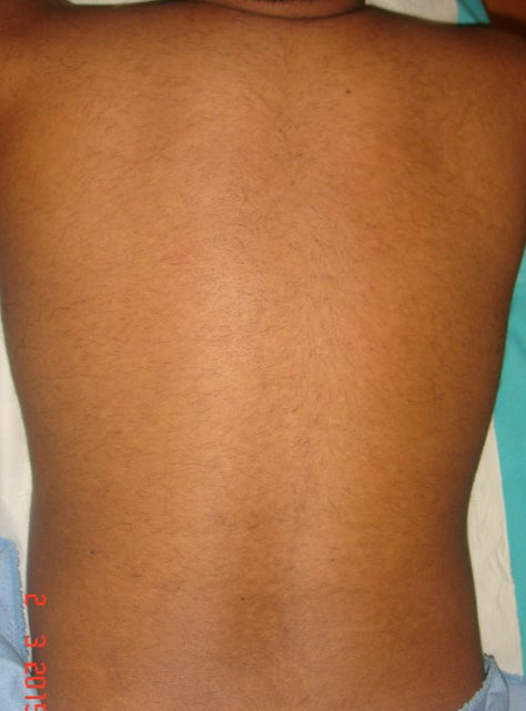 After Abdominal and Back Hair Removal