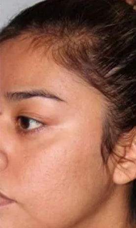 After Laser SCAR Removal