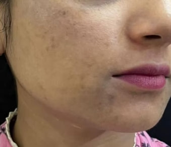 Before Dull Skin & Uneven Tone