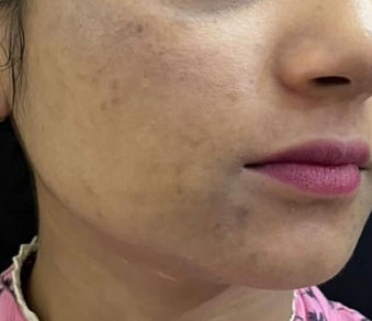 Before Laser Toning Q-Switch