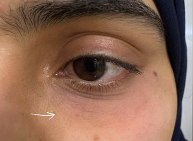 After Under Eye Filler