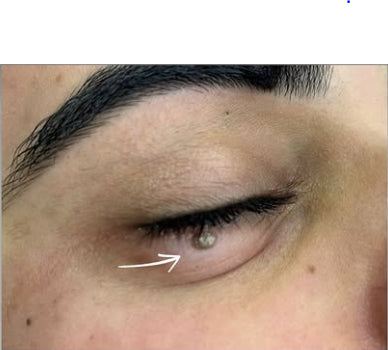 Before: Unwanted Moles