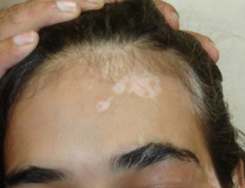 Before Vitiligo Treatment on Forehead