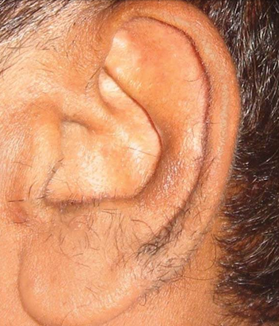 Before Ear Hair Removal