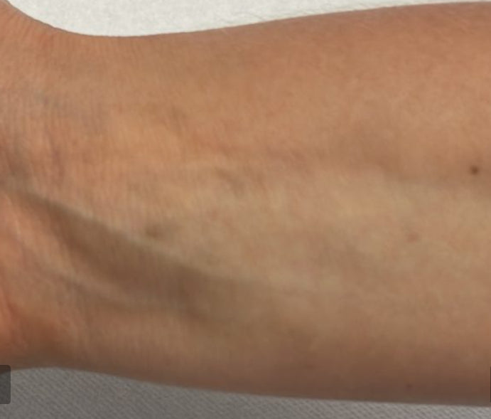 After Laser Tattoo Removal