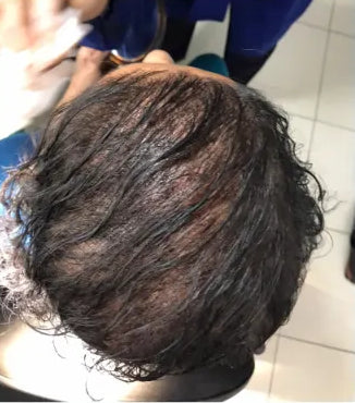 After Scalp Micro Pigmentation