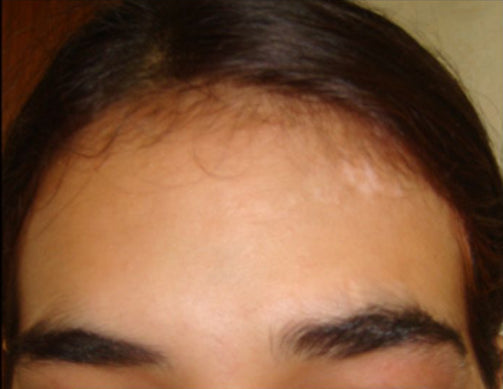 After Vitiligo Treatment on Forehead