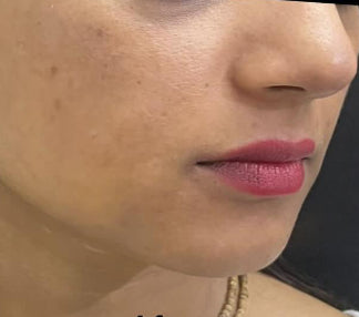 After Laser Toning Q-Switch