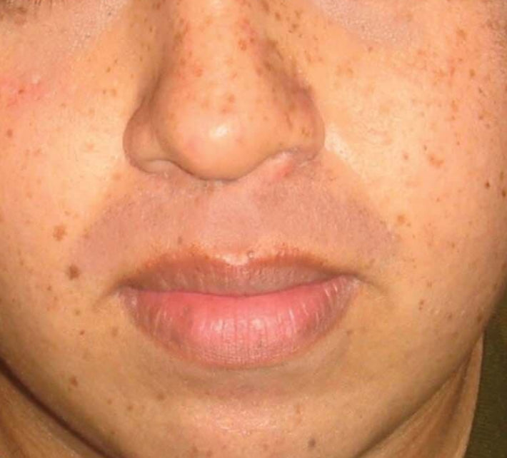 Before Pigmentation on Nose Treatment
