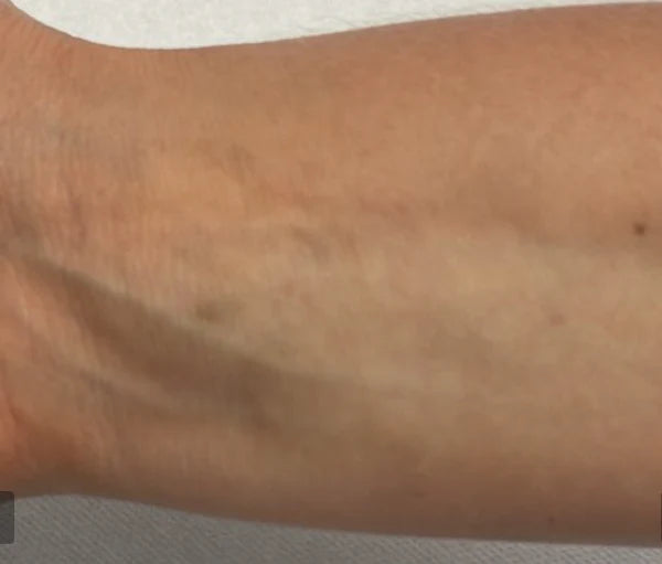 After Unwanted Tattoo