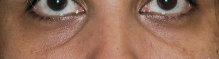 Before Fat Grafting Under Eye