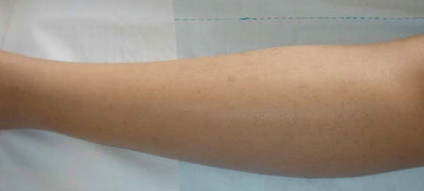 After: Thigh & Legs Hair