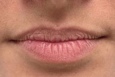 Before: Thin Lips