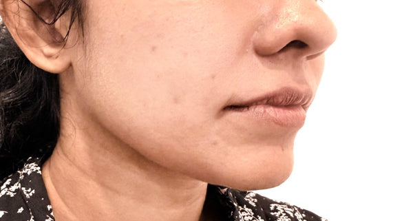 After Thread Lifting