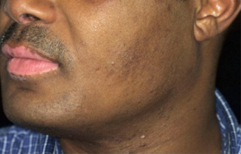 After Vitiligo Treatment on Face