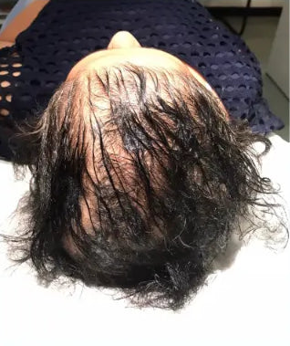 Before: Hair Loss / Thinning