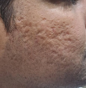 Before Fat Grafting ACNE SCAR Removal