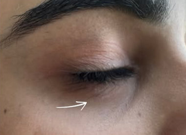 After: Unwanted Moles