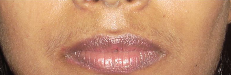 Before Upper Lip Hair Removal
