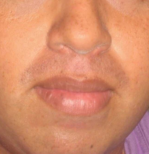 After Pigmentation on Nose Treatment