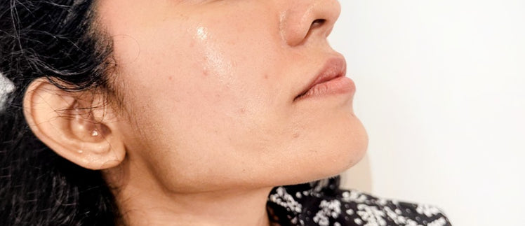 Before Thread Lifting