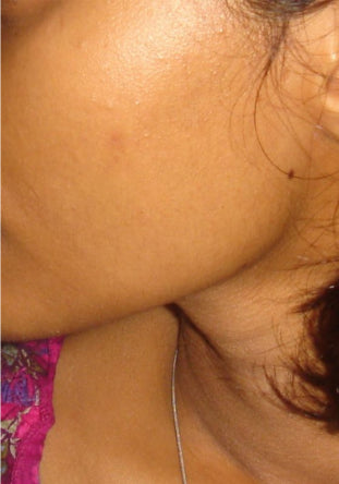 After Cheeks Hair Removal