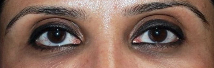 After Fat Grafting Under Eye