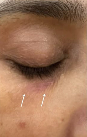 After Botox on Under Eye