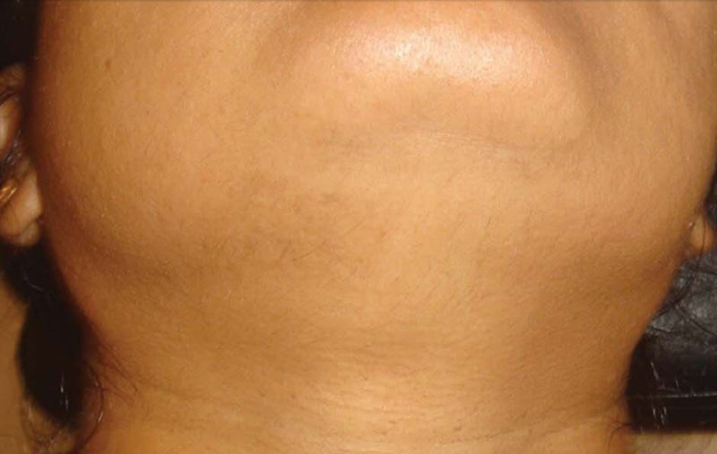 After Chin and Front Neck Hair Removal