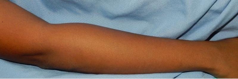 After Hand Hair Removal