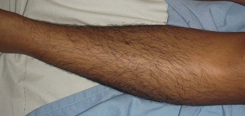Before Thigh and Legs Hair Removal
