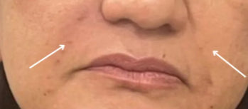 After Nasolabial Correction