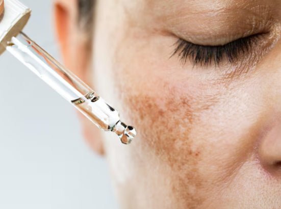 Melasma
