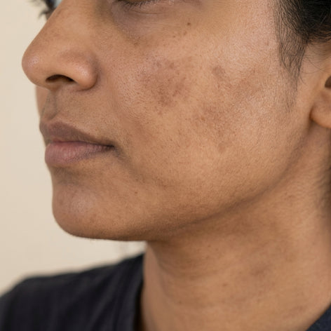 Skin Pigmentation Treatment