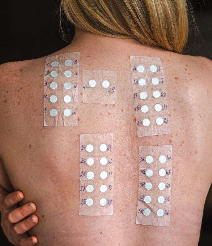 Allergy and Patch Test treatment at Allodermis — AIIMS MD dermatologist clinic in India